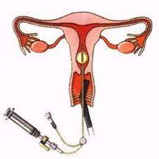 sonohysterogram
