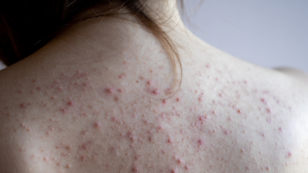 why is my acne itchy