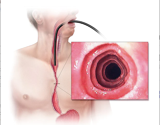 Eosinophilic Esophagitis