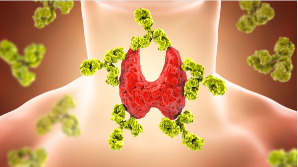 Hashimoto disease symptoms and naturopathic treatments